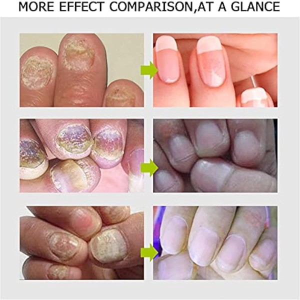 Efero Nail Treatment Repair Gel